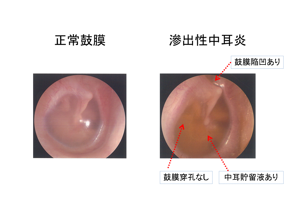 滲出性中耳炎とは何ですか?